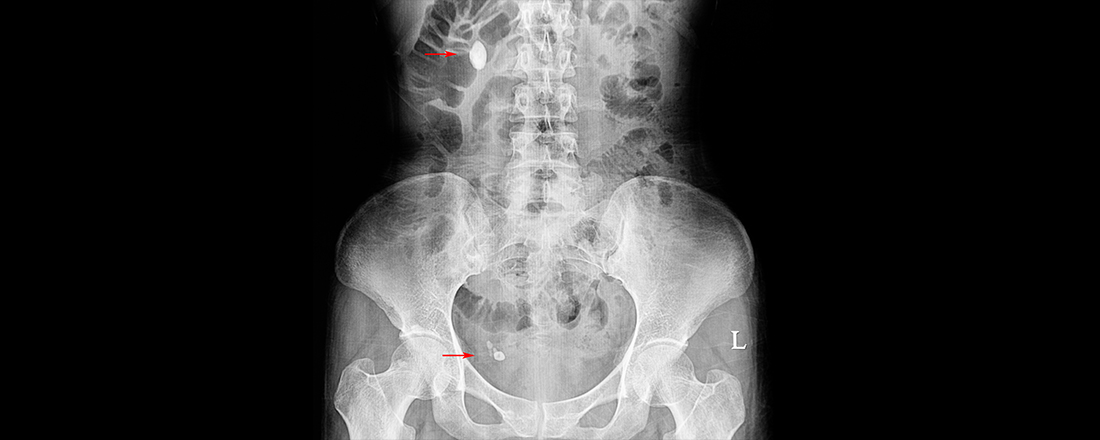 Xray showing multiple types of kidney stones